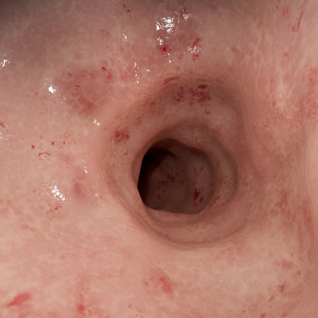 Darmschleimhaut mit leichter Entzündung