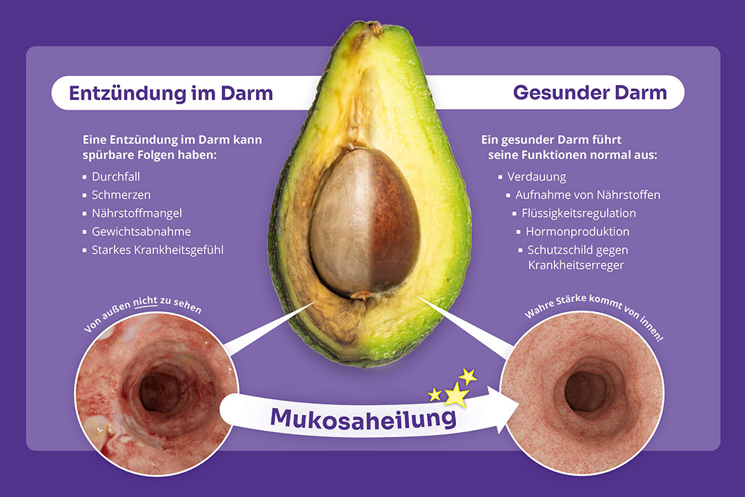 Darstellung eines entzündeten Darms und eines gesunden Darms mit Hilfe einer Avocado
