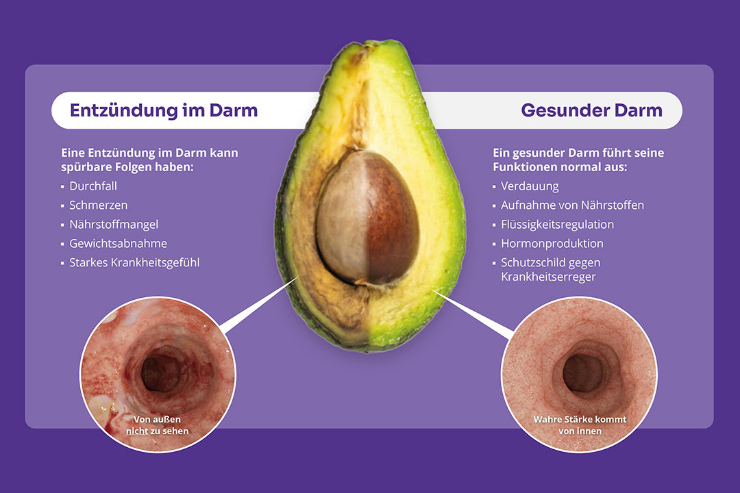 Darstellung eines entzündeten Darms und eines gesunden Darms mit Hilfe einer Avocado
