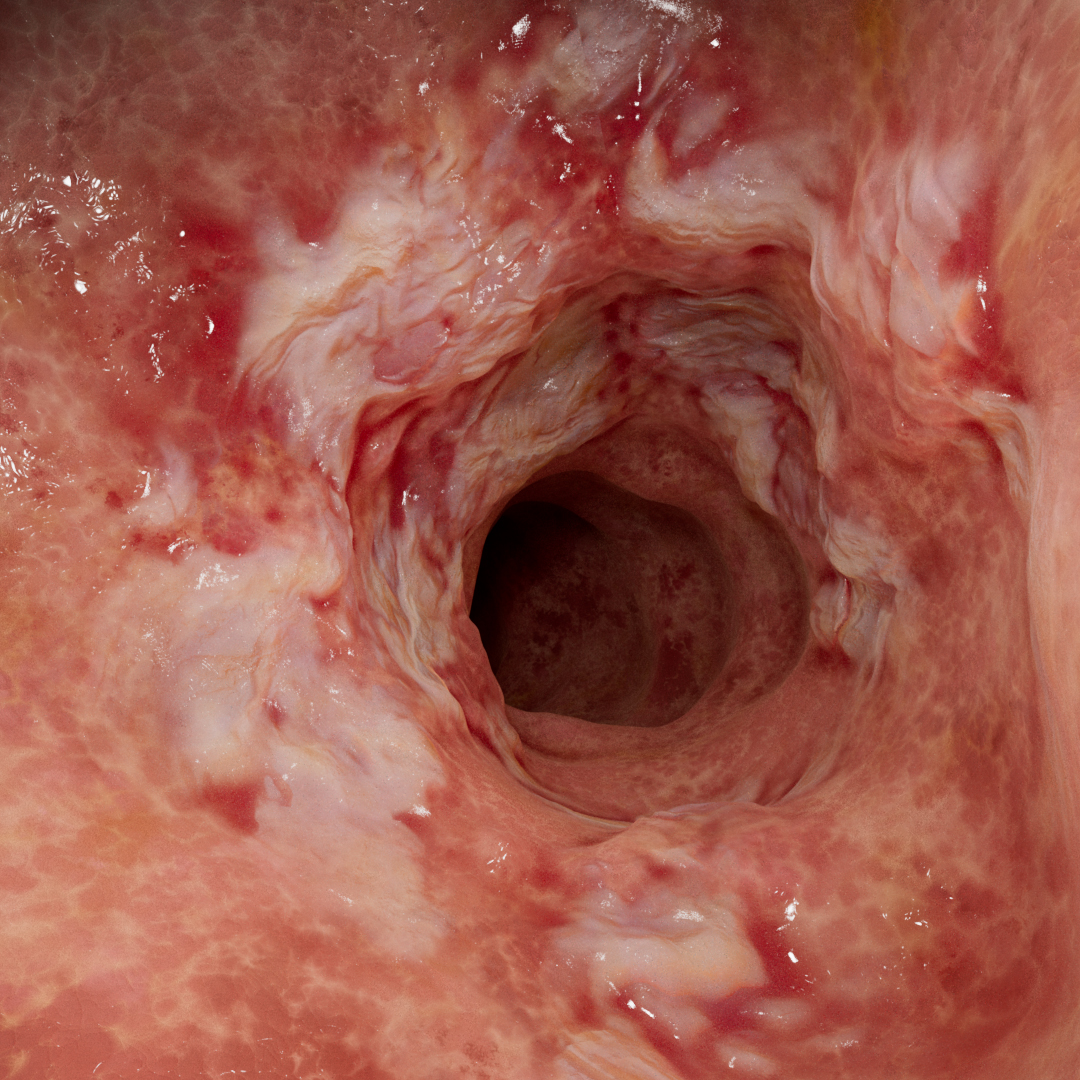 Entzündete Darmschleimhaut (Mukosa)